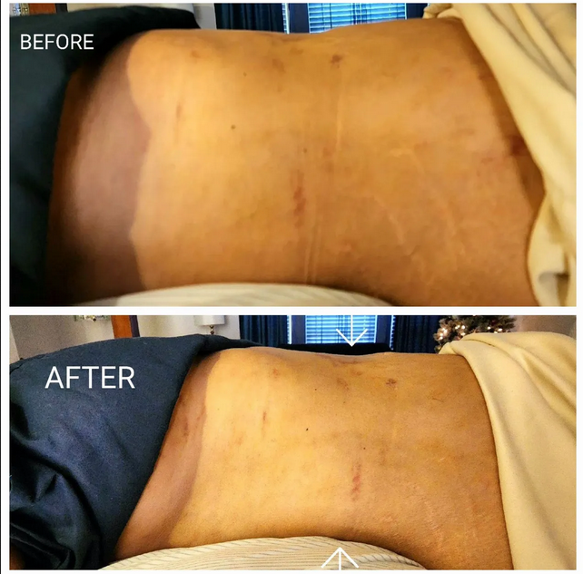 Lymphatic massage before and after results